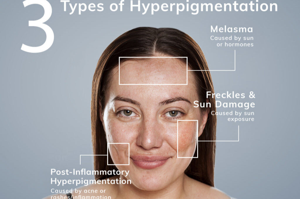 This Is Why Your Dark Spots Aren’t Going Away