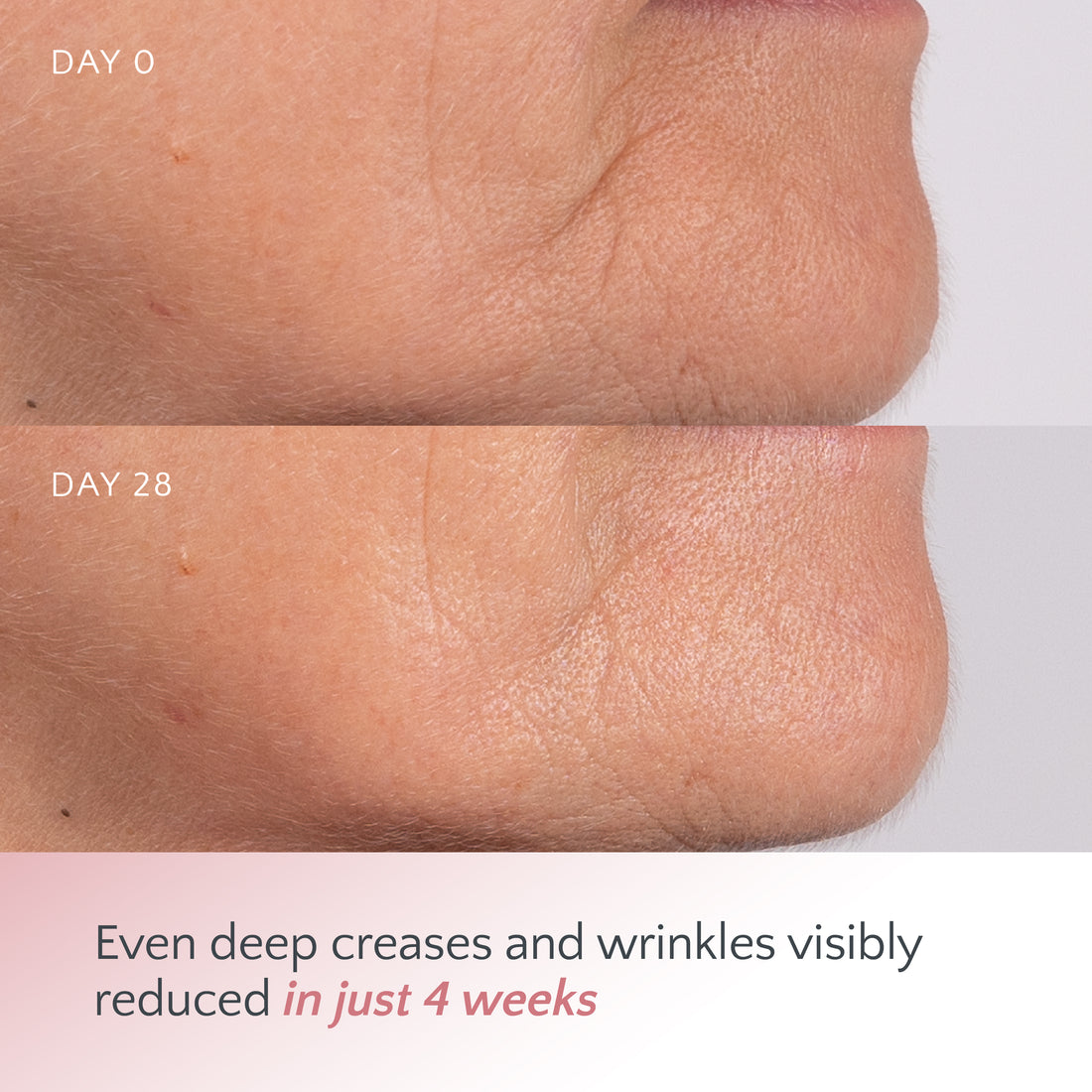 Freedom of Expression Line Limiter